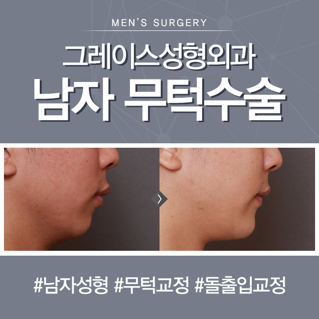 돌출입교정전후, 신사역 그레이스성형외과 무턱수술 관련 이미지 2