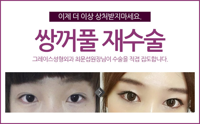 신사역 그레이스성형외과 최문섭원장님의 쌍꺼풀재수술 관련 이미지 2