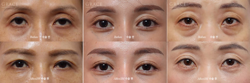 Why Does Fat Grafting to the Upper Eyelids Require a Different Approach from the Lower Eyelids? image 1