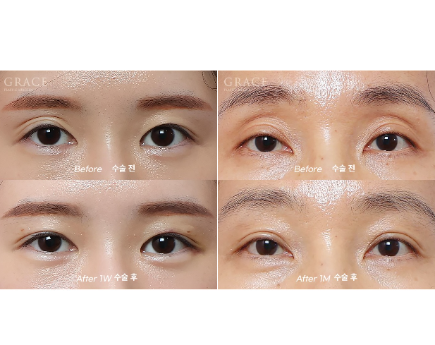 Recovery Timeline Before and After Eyelid Orbital Fat Grafting: 1 Week image 11