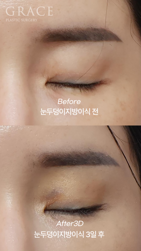 눈두덩이 지방이식 다운타임? 3일 후 흉터&middot;멍&middot;붓기 보여드립니다. 관련 이미지 3