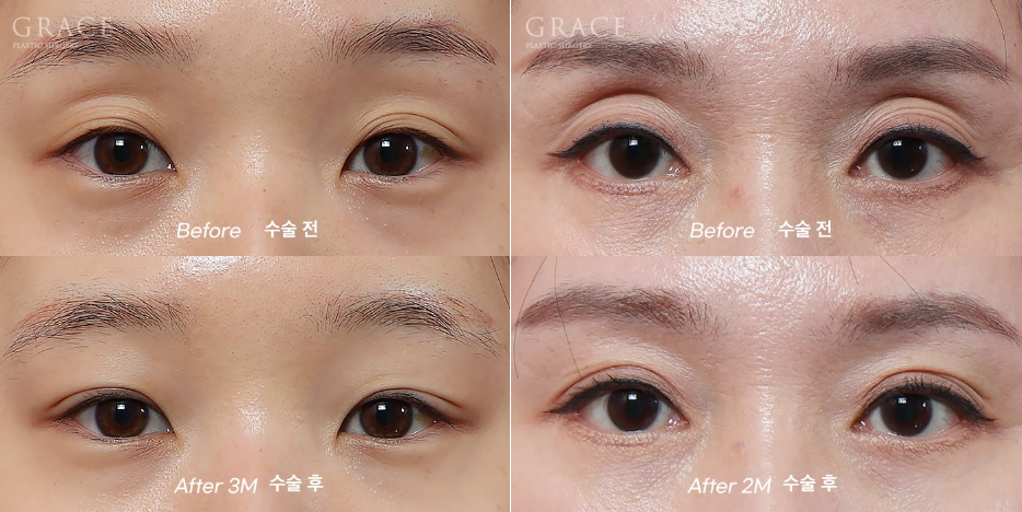 The Basis for a 94.5% Functional Improvement: Fat Grafting Technology That Fills in a Sunken Eye Hollow image 8