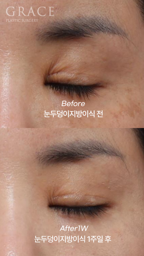 Week 1 After Upper Eyelid Fat Grafting in the Mid-40s: A Natural Return Without Swelling image 6