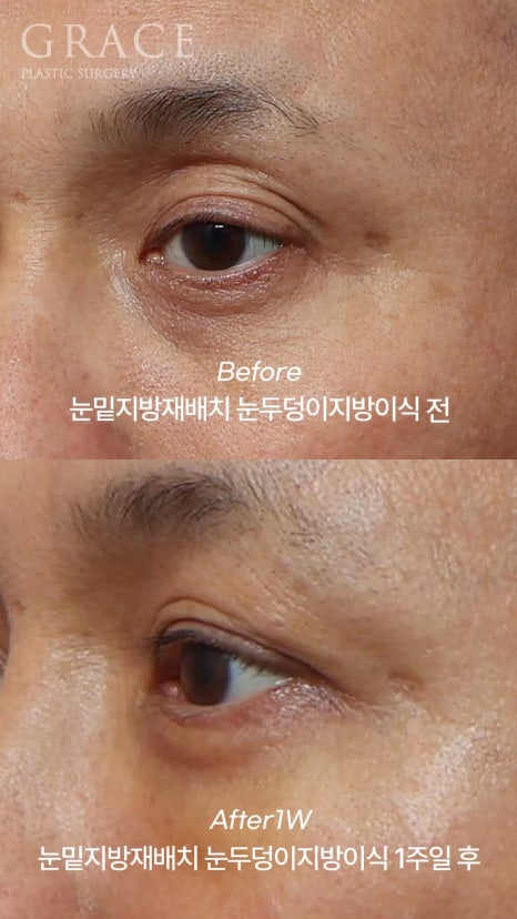 Eyebrow Hollow Fat Grafting Before and After Comparison – Gently Filling Sunken Eyes image 11