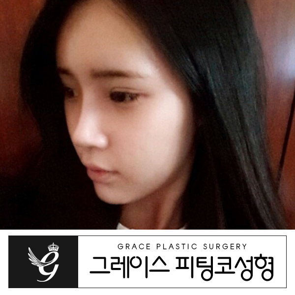 이런 코성형은 처음이라! 그레이스성형외과 피팅코성형!! 관련 이미지 3
