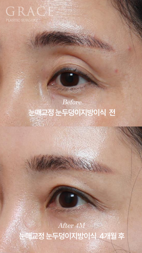 눈두덩이지방이식 11개월 후 부작용 없이 유지되는 변화 관련 이미지 5
