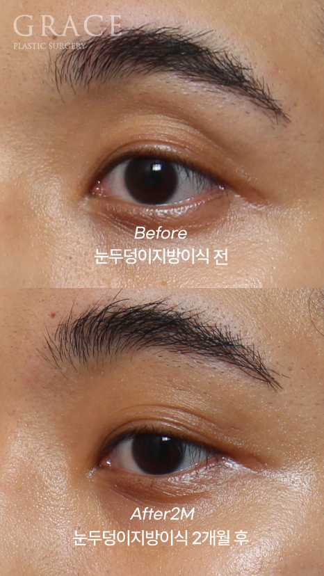 When the Eye Hollows Sink In, You Look Tired: Swelling After Fat Grafting for Men’s Eyes image 2