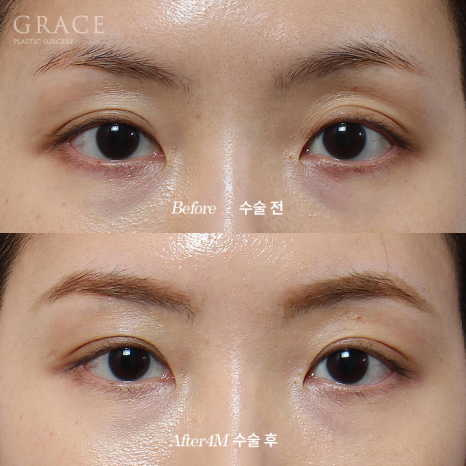 그레이스성형외과 Before&middot;After 아이홀 지방이식 잘하는 곳 관련 이미지 4