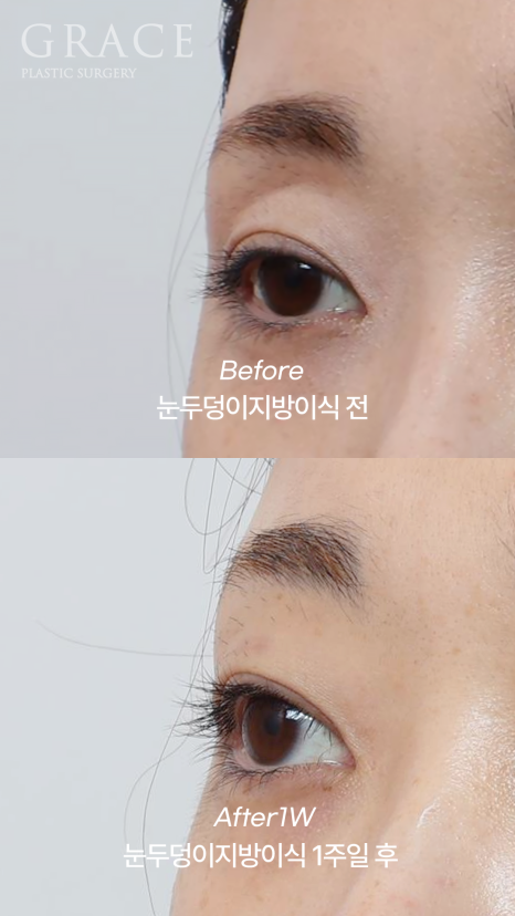 How to Fill Sunken Eyelid Hollows with Fat Grafting (Concerns About Filler Side Effects) image 3