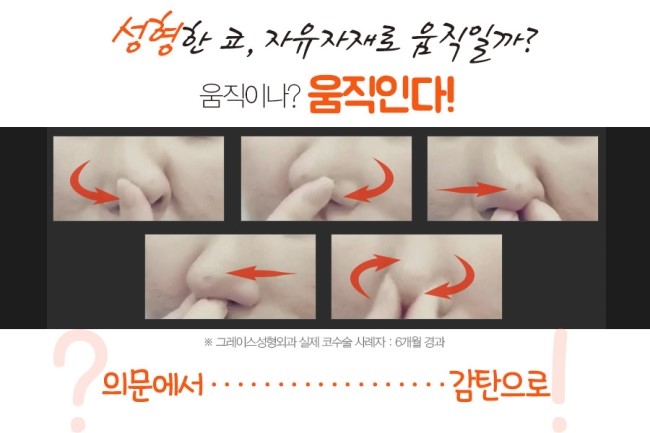 해외에서도 핫한 그레이스성형외과의 피팅코성형! 관련 이미지 4