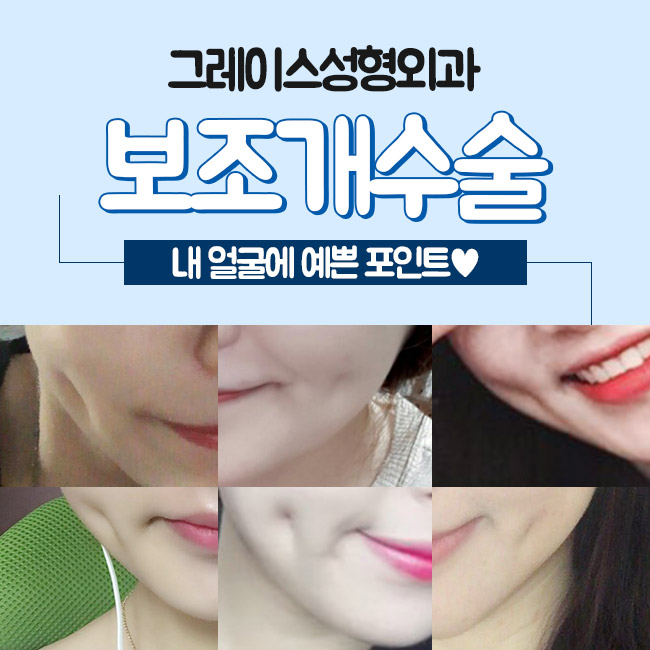 만족스러운 후기와 보조개수술가격 관련 이미지 2