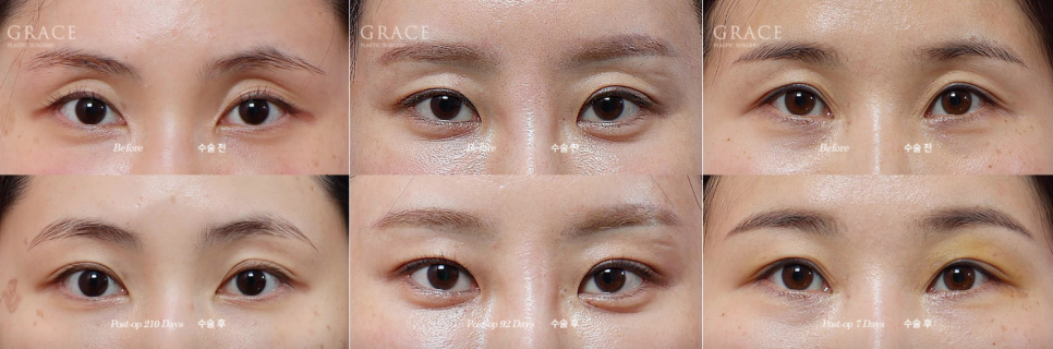 Looking into the Cost of Upper Eyelid Fat Grafting? What Really Matters Is More Than the Price..... image 5