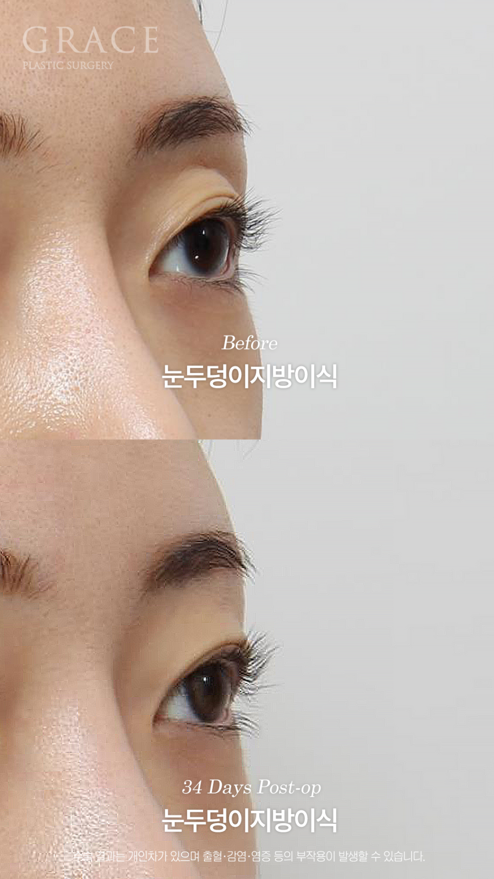 눈두덩이 지방이식이 필요한 경우 진료실에서는 무엇을 볼까요? 관련 이미지 5
