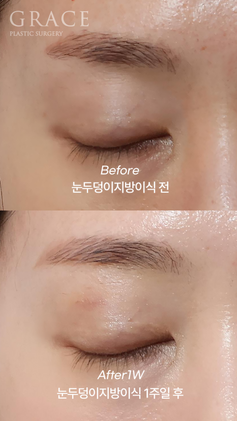 눈꺼풀 지방이식 잘하는 병원 그레이스성형외과 관련 이미지 3