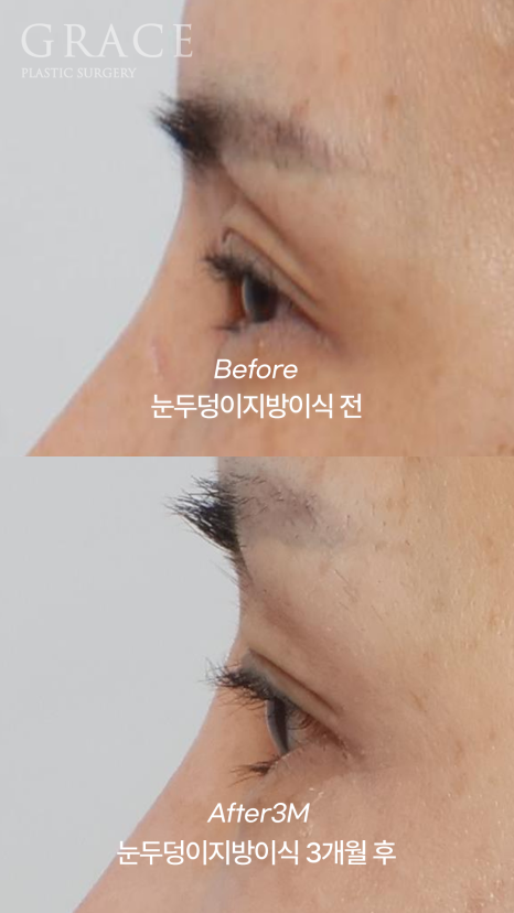 Grace Plastic Surgery 40s Case: Improved Eye-Opening Strength After Upper Eyelid Fat Grafting image 5