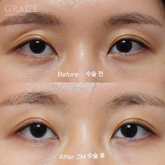 Understanding the Difference Between Forehead Fat Grafting (Eye Hollow Fat Grafting) and Fillers image 8