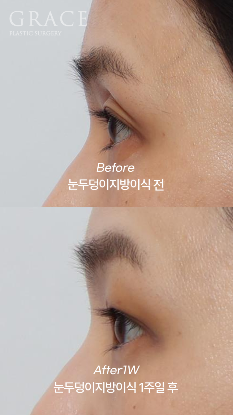 1 Week After Forehead Fat Grafting for Sunken Eyes: Honest Swelling Update image 2