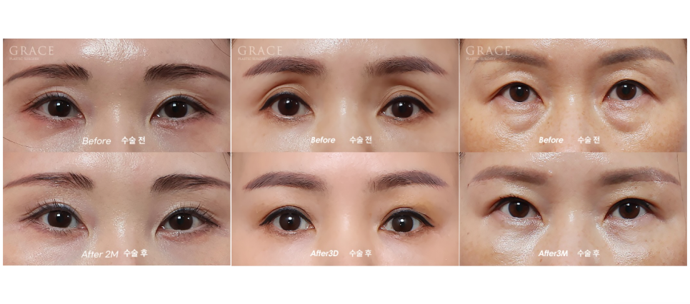 If You’re Curious About Eyelid Fat Grafting Reviews, Costs, Prices, and Side Effects image 3