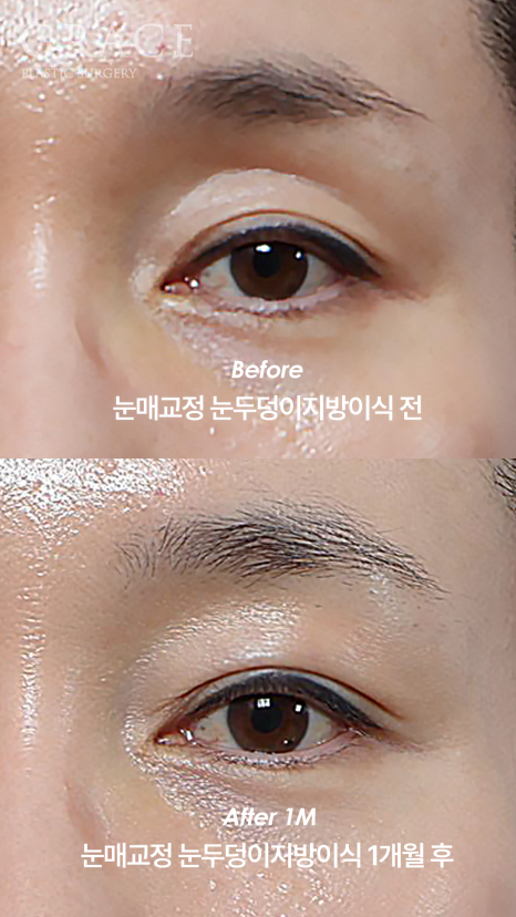 What Is the Problem with the Side Effects of a Lumpy Eyelid Fat Graft? image 6