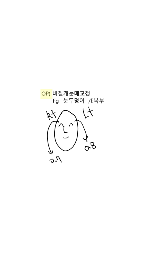 꺼진 눈두덩이와 눈 뜨는 힘을 함께 개선하면? 눈두덩이지방이식 눈매교정 전후 관련 이미지 3