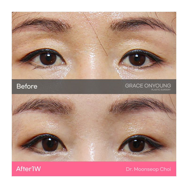 Eyelid Fat Grafting (Sunken Eye Hollowing) image 4