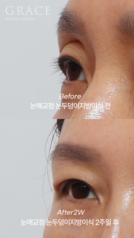 2-Week Swelling Progress After Upper Eyelid Fat Grafting + Incisional Ptosis Correction in Your 40s image 2