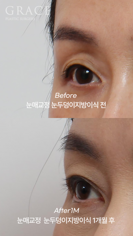 눈두덩이 지방이식 비절개 눈매교정 반드시 필요할까? (초이칼럼) 관련 이미지 6