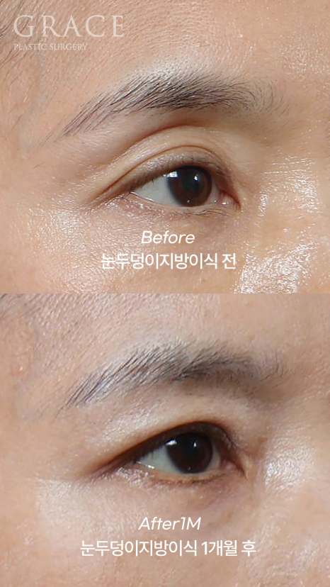 눈꺼풀 지방이식 절개 없이 아이홀 부위를 채우기 관련 이미지 7