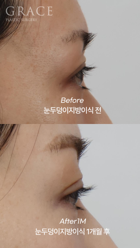 How Long Does Upper Eyelid Fat Grafting Last? The Facts About Maintenance Period image 6
