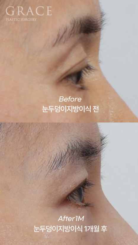 눈꺼풀 지방이식 절개 없이 아이홀 부위를 채우기 관련 이미지 6