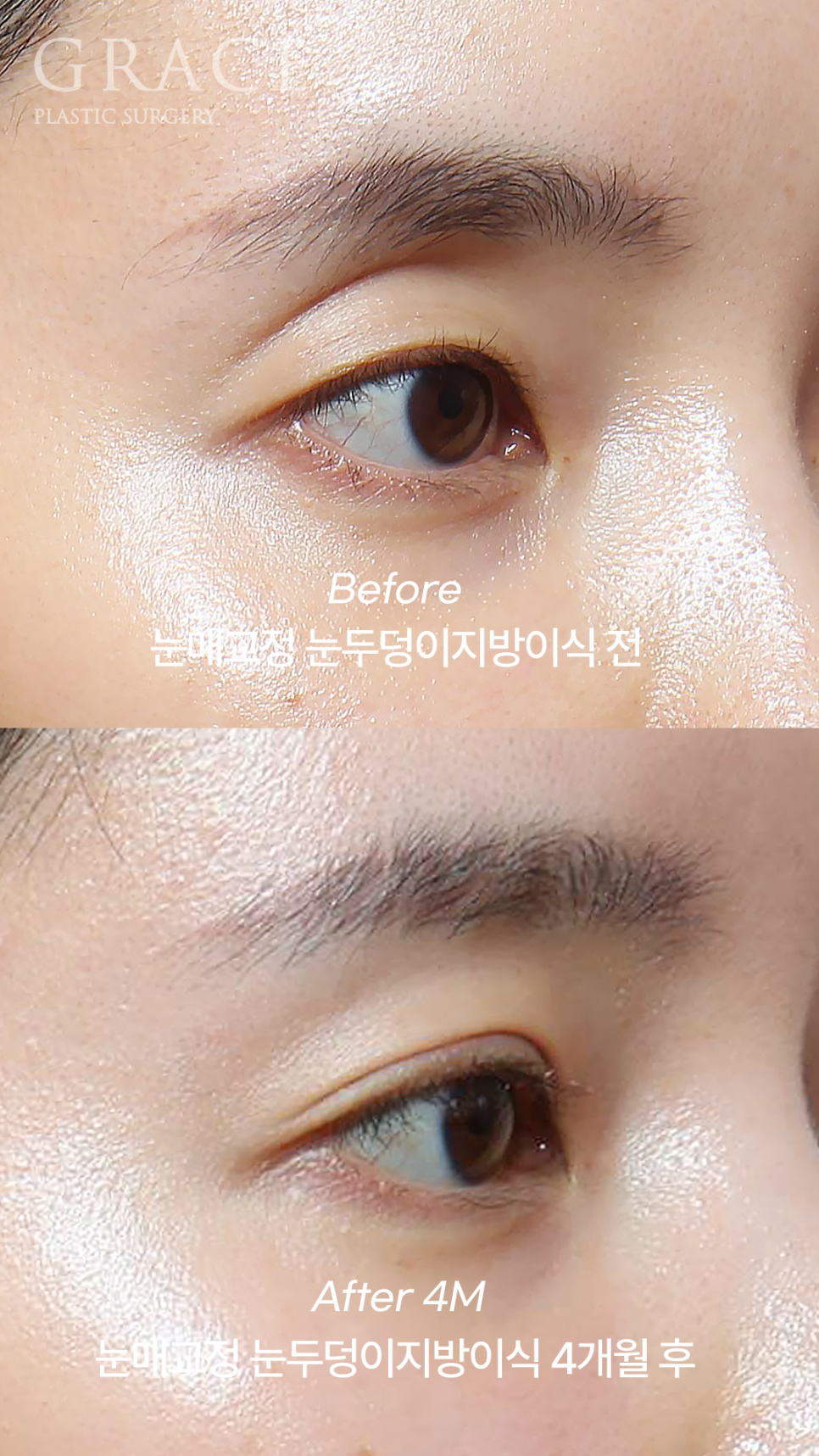 눈꺼풀 지방이식 부작용 왜 생기는지 아시나요? 관련 이미지 5