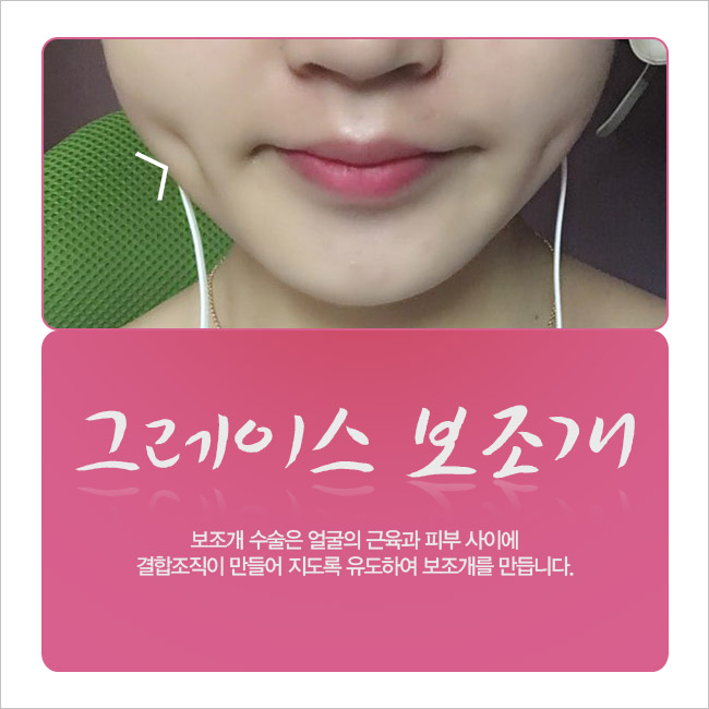 이미지 변신은 그레이스성형외과 보조개 수술 관련 이미지 2