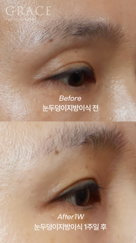 눈두덩이 지방이식 부작용 걱정된다면? 아이홀 지방이식 전후 30대 안와지방이식 관련 이미지 5