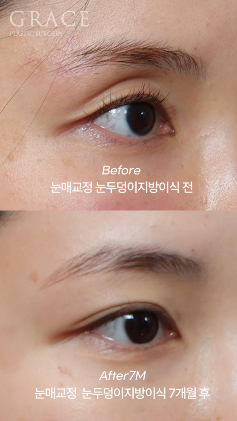 [20대 후반 눈꺼풀 지방이식+눈매교정]  7개월 후 유지력 이렇게 좋을 일? 관련 이미지 3