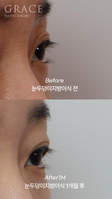 …The Result of Eyelid Fat Grafting (If You’re Worried About Side Effects and Swelling) image 5