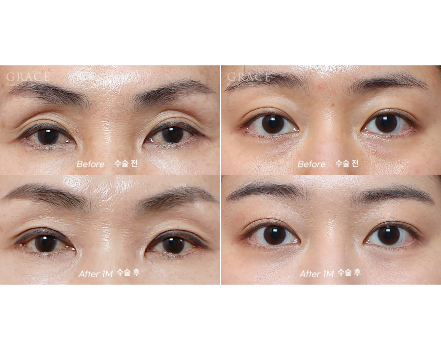 What Matters More Than Swelling After Eye Hollow Fat Grafting: Injection Location and Survival image 1