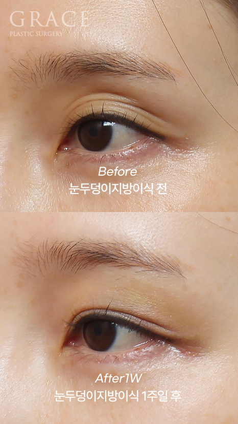 Will Eye Hollow Fat Grafting Really Deflate After 1 Month? 1-Week vs 2-Month Before-and-After Comparison image 3