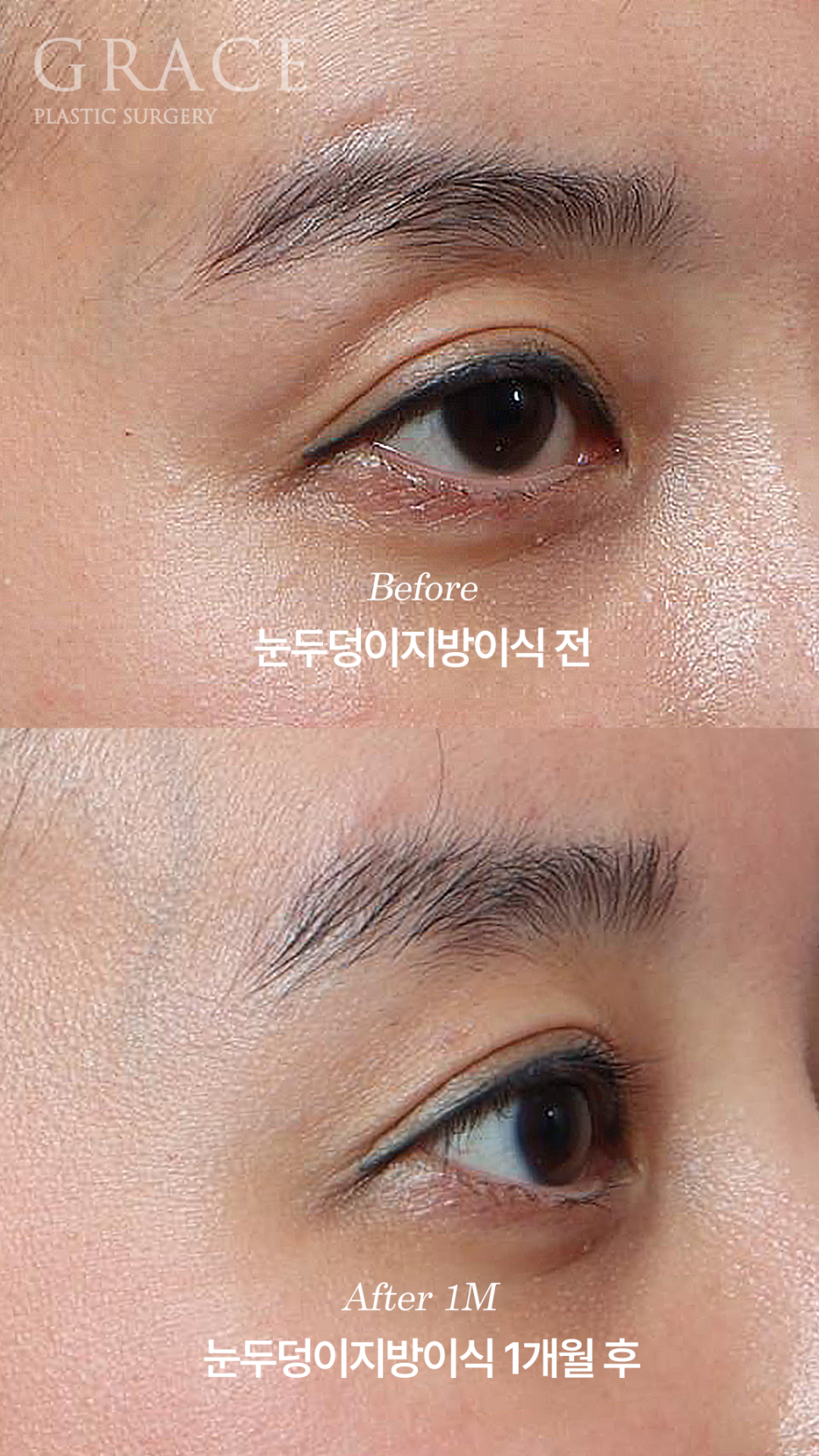 Why Choose Upper Eyelid Fat Grafting Instead of Eye-Hollow Filler? image 7