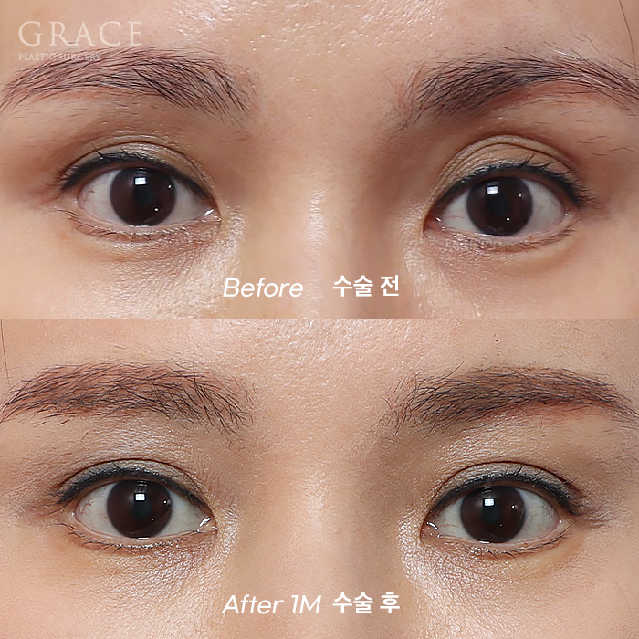 Upper Eyelid Fat Grafting Side Effects? The Difference in Survival Rates Between Frozen Fat and Fresh Fat image 4