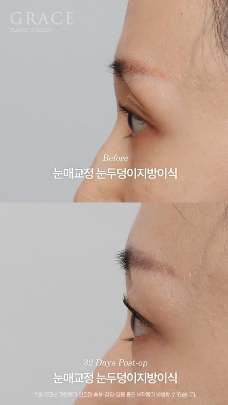Will a Sunken Upper Eyelid Become Bumpy When You Close Your Eyes After Fat Grafting? image 17