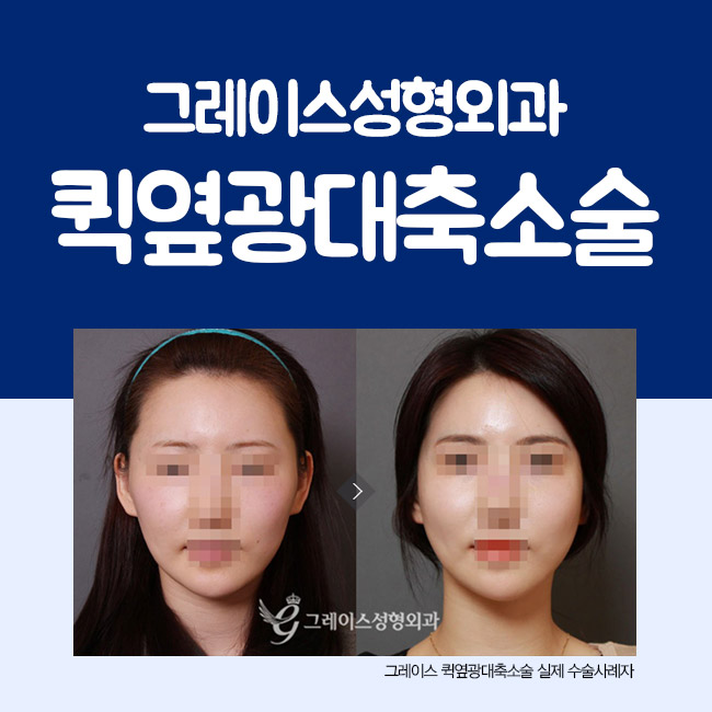 옆광대작아지는법, 옆광대축소를 알아본다면 관련 이미지 4