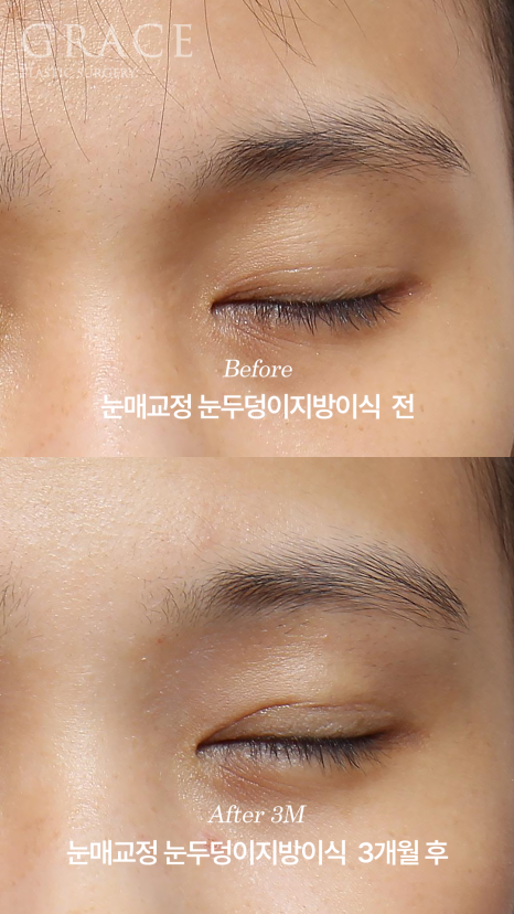 눈두덩이지방이식 붓기 언제 빠질까? 부작용&middot;유지기간까지 1주&middot;3개월&middot;6개월 변화 관련 이미지 5