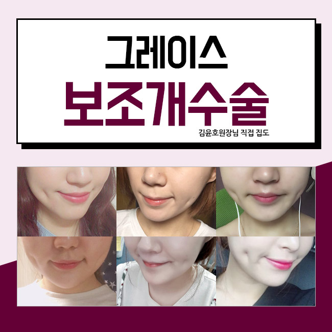 신사역 그레이스성형외과 김윤호원장님의 보조개수술 관련 이미지 2