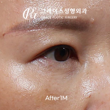 A Complete Guide to the Best Combination of Midlife Eye Surgery, from Under-Eye Fat Repositioning Costs to an I-Hole Filler Alternative image 8
