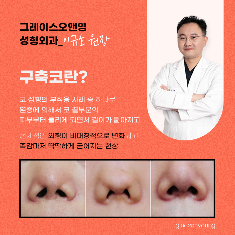 Advanced Nose Revision Surgery for Contracted Nose at Grace O&Young image 2