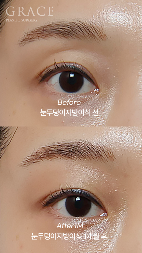 눈두덩이 꺼짐 개선을 위한 지방이식 관련 이미지 4