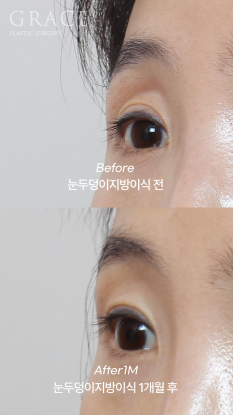 연예인도 고민한다는 아이홀 필러 부작용? 눈두덩이 지방이식으로 자연스럽게 관련 이미지 1