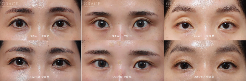 Why Eyelid Hollow Fat Grafting Fails If You Don’t Know This image 1