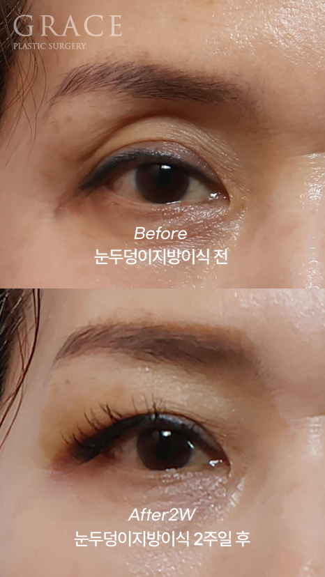 Concerns About Swelling and Side Effects After “Eye Hollow Fat Grafting” Surgery in the Eye Socket Area for People in Their 60s image 4