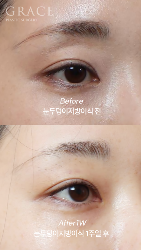 How to Fill Sunken Eyelid Hollows with Fat Grafting (Concerns About Filler Side Effects) image 4